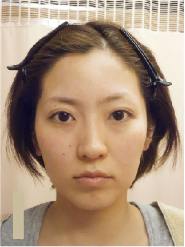 小顔矯正のビフォーアフター