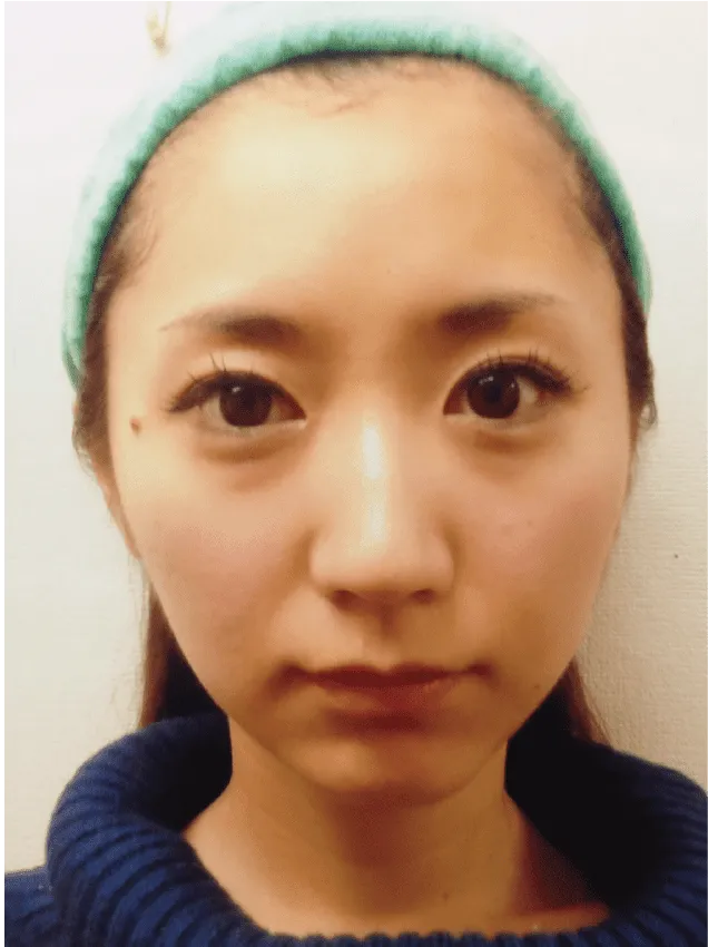 小顔矯正のビフォーアフター