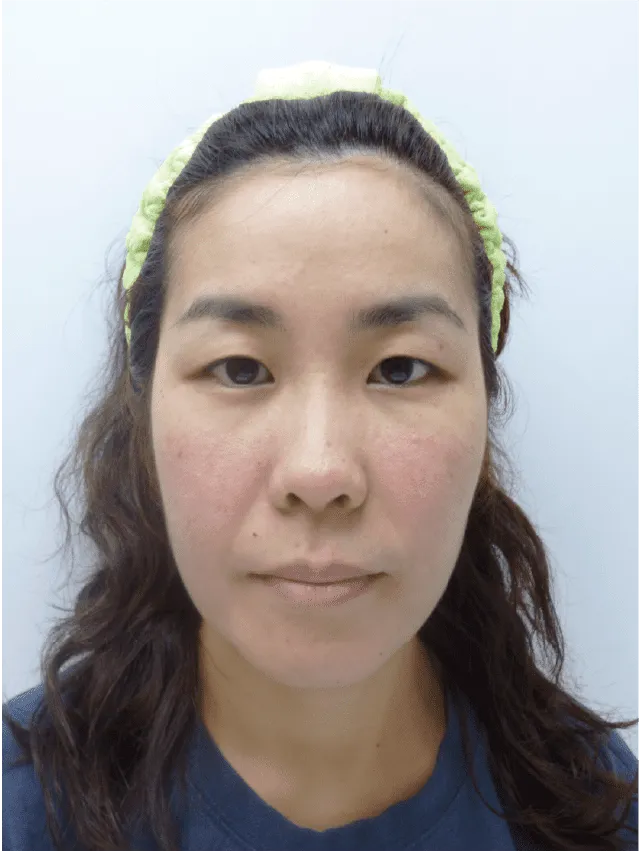 小顔矯正のビフォーアフター