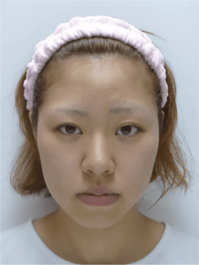 小顔矯正のビフォーアフター