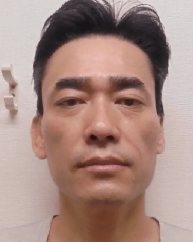 小顔矯正のビフォーアフター