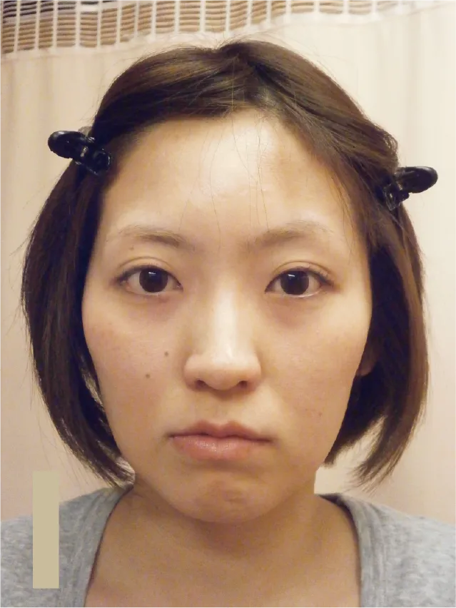 小顔矯正のビフォーアフター