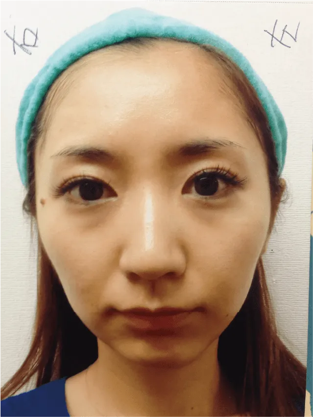 小顔矯正のビフォーアフター
