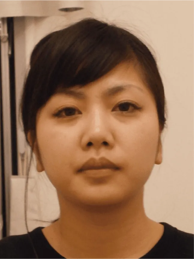 小顔矯正のビフォーアフター