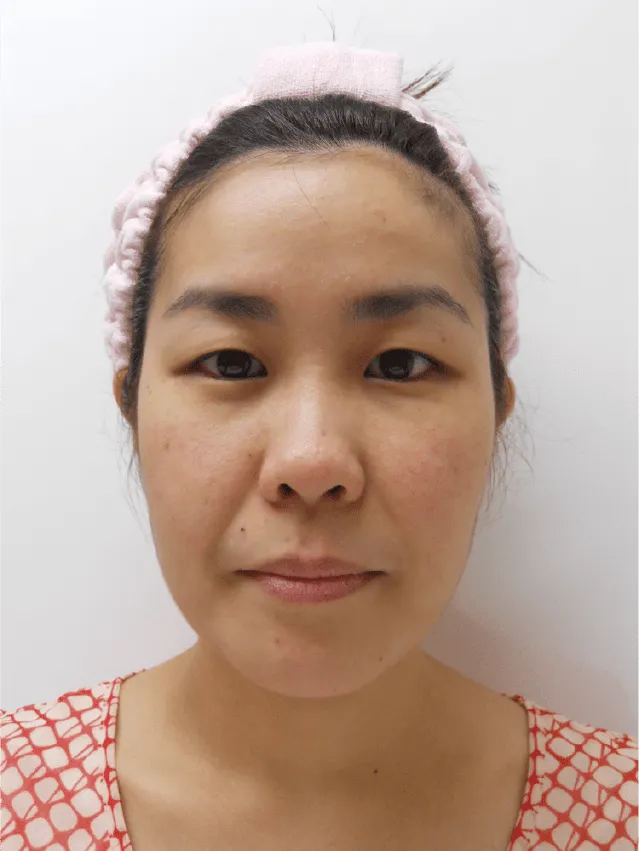 小顔矯正のビフォーアフター