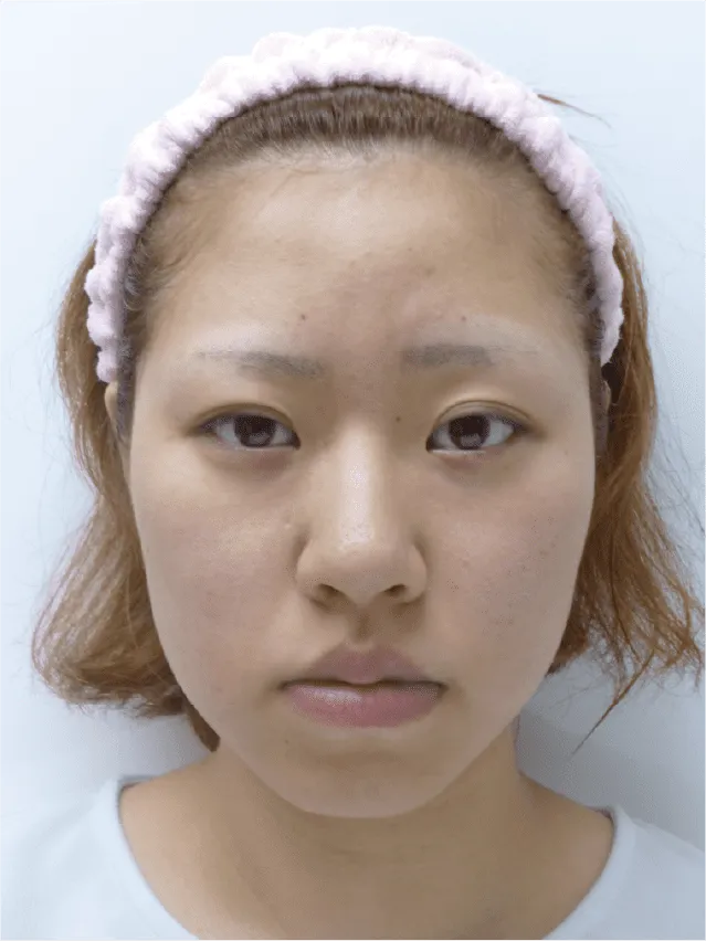 小顔矯正のビフォーアフター